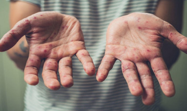 Azərbaycanda qızılca ilə bağlı vəziyyət necədir?