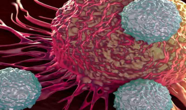 Gənclər arasında ən çox bu xərçəng növü yayılmağa başladı - xəbərdarlıq