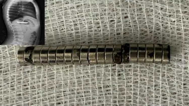 3 yaşlı uşağın boğazından 19 maqnit çıxarıldı - FOTO