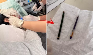 22 yaşlı qadının mədəsindən qələm çıxdı - FOTO