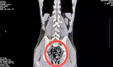 Türkiyədə Narkotik daşımağın bu üsulu hamını şoka saldı