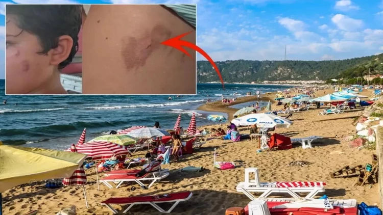 İnsanlar narahatdır: Dənizə girənlər bədəndə yanıq izləri ilə çıxır