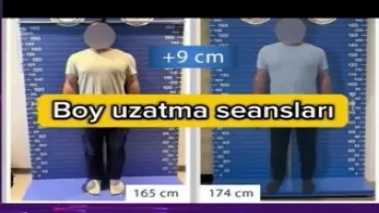 Sosial şəbəkələrdə paylaşılan aparatla 9 santimentrə qədər boy uzadılır? - VİDEO