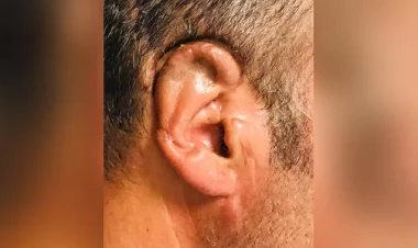 Bakıda kişinin qopan qulağını 34 saat sonra yerinə tikdilər - FOTO