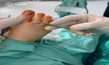 Bakıda uşağın ayağındakı iynə 14 gün sonra tapıldı - FOTO