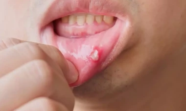 Adi yara bilirdi, xərçəng çıxdı: 23 yaşlı qadın dilini itirdi