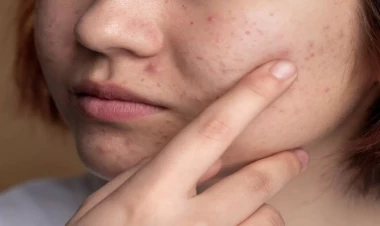 Sızanaq peyvəndi hazırlandı - Dünyada ilk