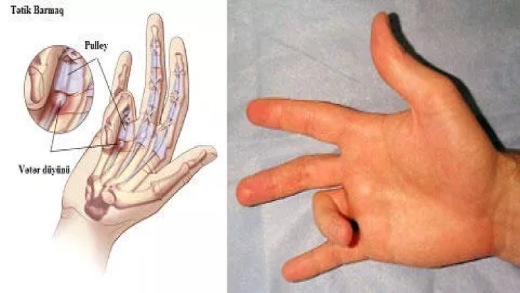 Barmaqları şaqqıldatmaq vərdişi bu halda təhlükəsizdir