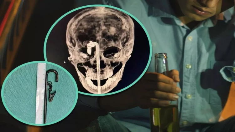 İçki içdi, dəhşət yaşadı - Metal çubuq beyninə qədər irəlilədi - FOTOlar