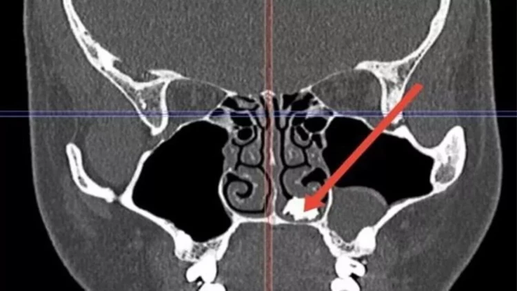 Qrip şikayəti ilə həkimi getdi, burnundan diş çıxdı - FOTO