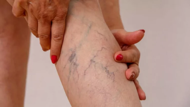 Ayaqlarda ölümlə nəticələnə bilən qan laxtalanmasının üç xəbərdaredici əlaməti