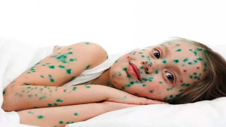 Ölkəyə suçiçəyi əleyhinə peyvənd gətiriləcək?