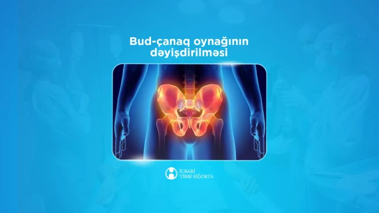 İcbari tibbi sığorta bud-çanaq oynağının süni protezlə dəyişdirilməsi əməliyyatını qarşılayır