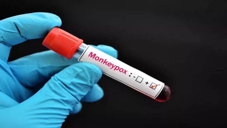 İsveçdə meymunçiçəyinin yeni variantına ilk yoluxma qeydə alınıb