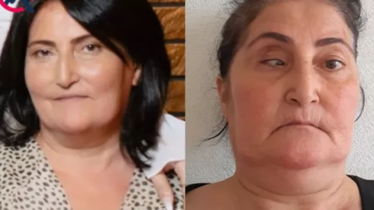 Burun əməliyyatına girən qadının gözü çəpləşdi - FOTO