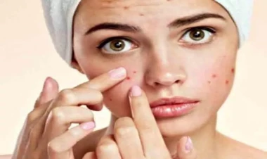 Sızanaqların kökünü kəsən vasitələr