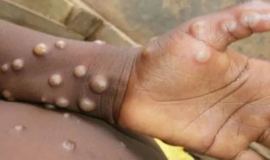 Bu ölkədə meymunçiçəyi epidemiyası elan edildi