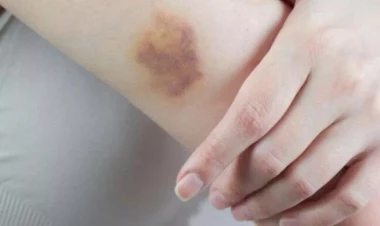 Bədəndəki göyərmələr bu xəstəliyin əlamətləri imiş...