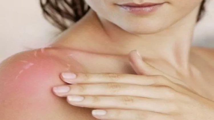 Günəşlənmənin təhlükəli TƏRƏFLƏRİ