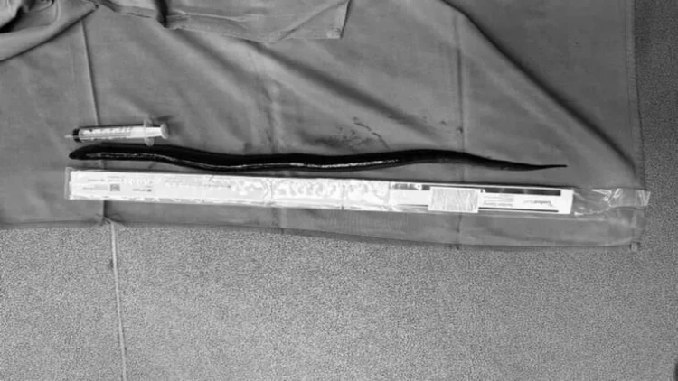 Mədəsindən canlı ilan balığı çıxarıldı