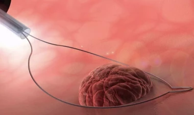 Mədə-bağırsaqda xərçəngə səbəb poliplər – Necə yaranır?