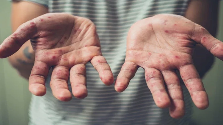 Rayonlarda qızılcanın artma səbəbi