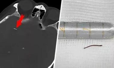 Kişi beynindəki iynə ilə 20 İL YAŞADI