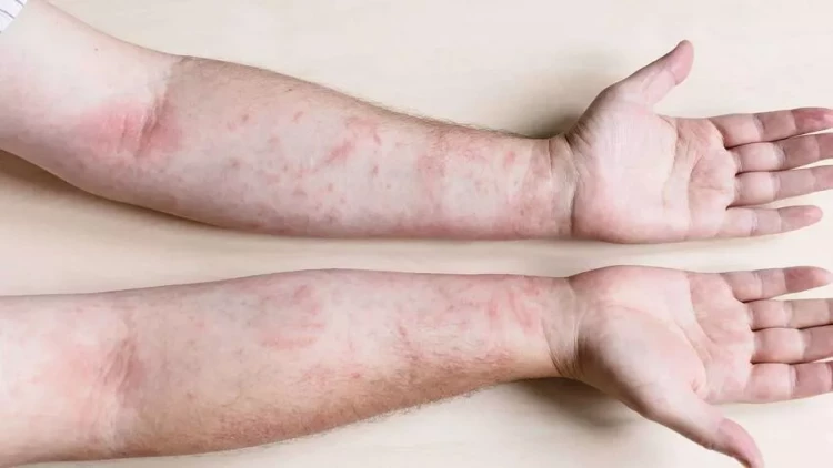 Bu bölgəmizdə qızılcaya yoluxma sayında  yenidən artdı