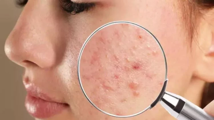 Qışda üzdə niyə sızanaqlar çıxır? - KOSMETOLOQ AÇIQLADI