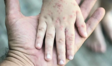 Gürcüstanda qızılcaya yoluxma kəskin artıb