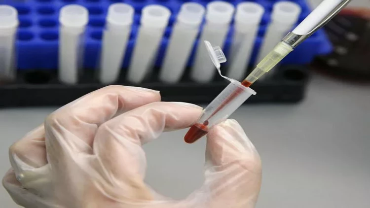 SN: Bu şəxslər Hepatit A virusuna daha çox yoluxur