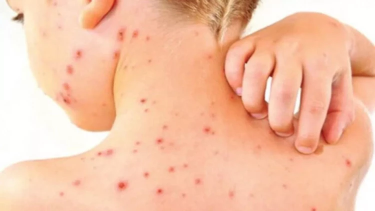 Azərbaycanda qızılca ilə bağlı son vəziyyət açıqlandı