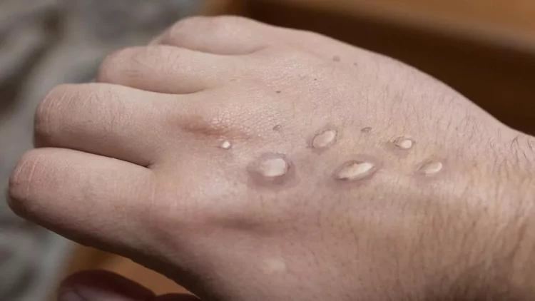 Rusiyada meymunçiçəyi virusuna iki yoluxma qeydə alınıb