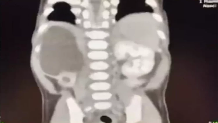 4 böyrəkli uşaq doğuldu - FOTO