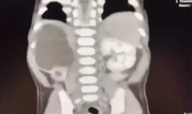 4 böyrəkli uşaq doğuldu - FOTO