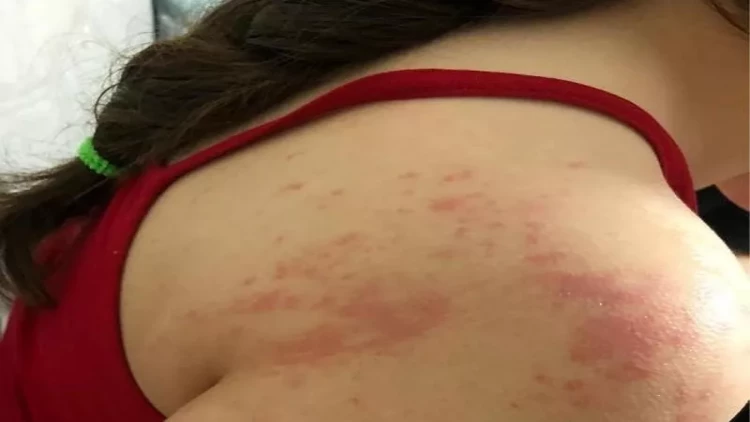 Aptekdən aldığı dərman qızın bədənini bu hala saldı - FOTO