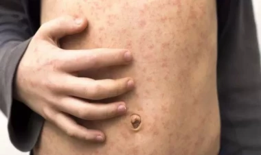 Azərbaycanda yayılan qızılca nədir? 7 suala cavabda