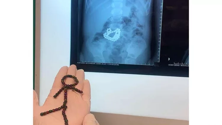 Bakıda 4 yaşlı uşaq 53 maqnit udub - FOTOlar