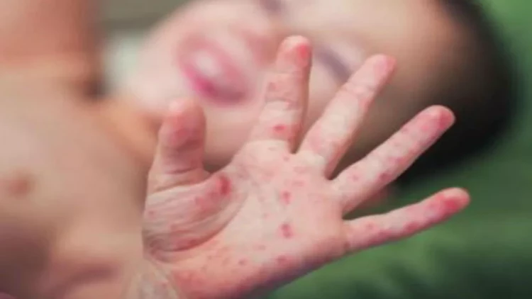 Ölkədə koronavirus və qızılca tüğyan edir - Həkimdən HƏYƏCAN TƏBİLİ