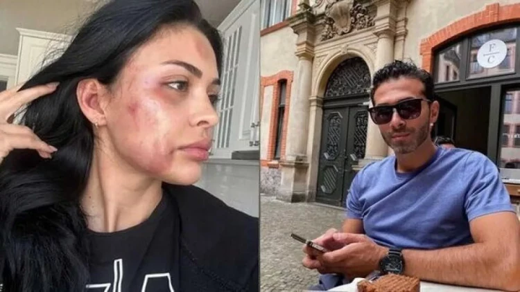 Tanınmış modeli döyməkdə ittiham olunan şəxsin istintaqı tamamlandı