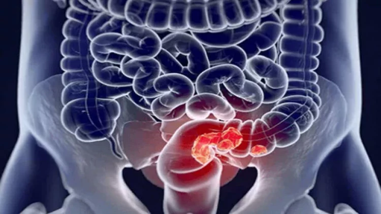 Xərçəng xəstəliyinin ilkin əlamətləri bunlardır