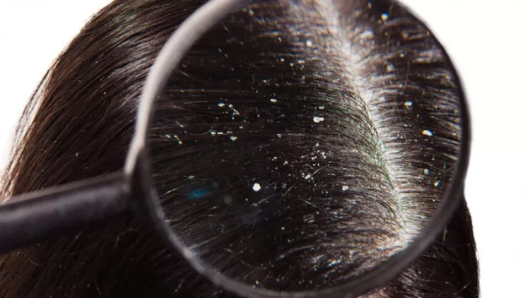 Başınızda kəpək var? - dəhşətli fəsadları...