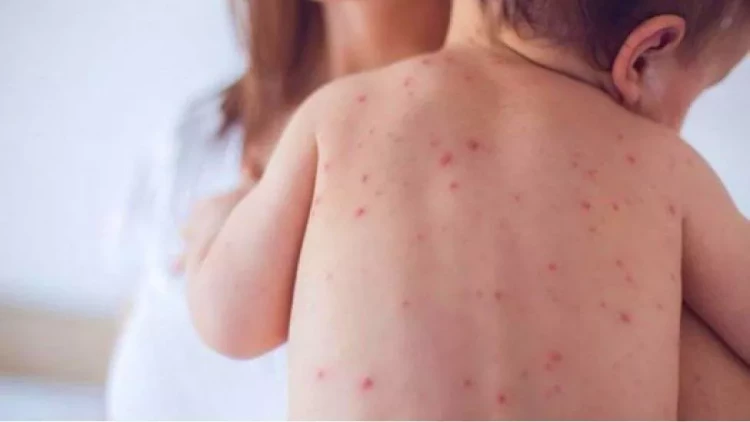 Ölkədə qızılca ilə bağlı vəziyyət necədir? - Səhiyyə naziri AÇIQLADI