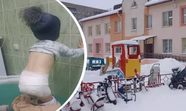 Uşaq bağçasında DƏHŞƏT: uşağı qaynar su ilə yandırdılar - FOTO