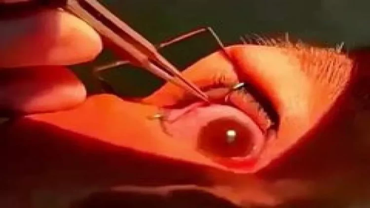 Həkimlər qadının gözündən 60 diri qurd çıxardılar