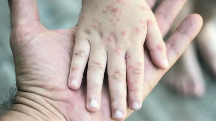 Bu ölkədə qızılca epidemiyası elan edildi