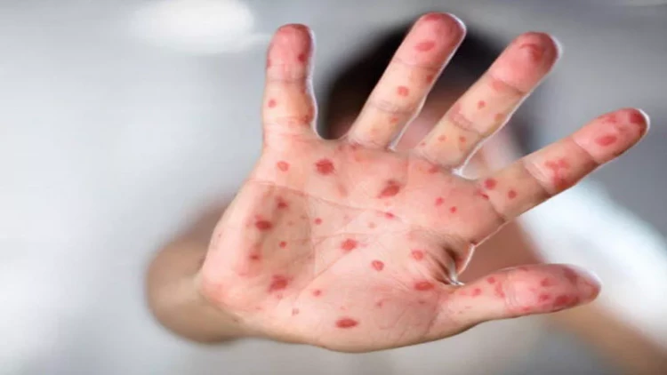 Qızılcanı kimlər ağır keçirir? - Nazirlik AÇIQLADI