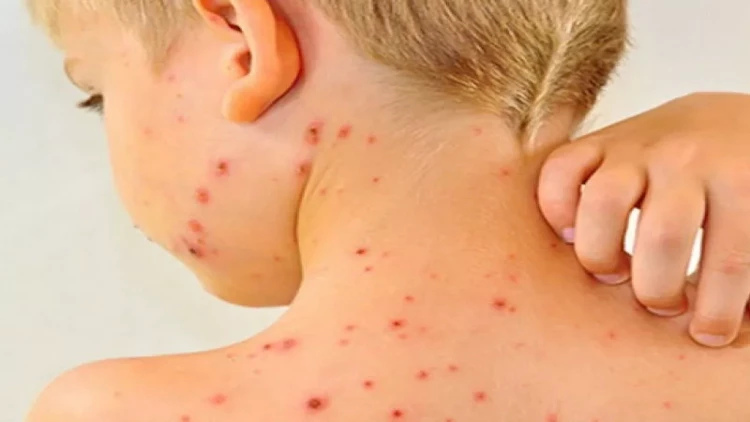 Qızılca virusu insanlar arasında necə yayılır?