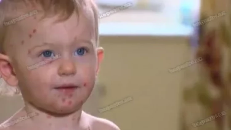 Vaksin olunan uşaqlar da qızılcaya yoluxa bilərlər - VİDEO