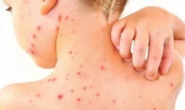 Əvvəllər qızılca keçirənlər ikinci dəfə yoluxa bilərlər?